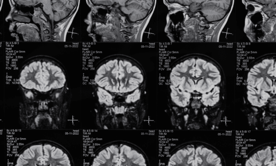 Exploring the Vital Attributes of Lawyers in Traumatic Brain Injury Cases 